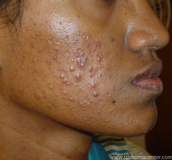 Acne-Before